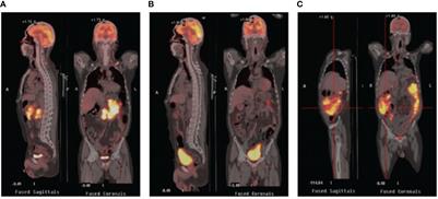 Circulating tumor DNA determining hyperprogressive disease after CAR-T therapy alarms in DLBCL: a case report and literature review